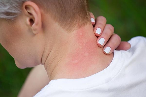 dengue-symptoms